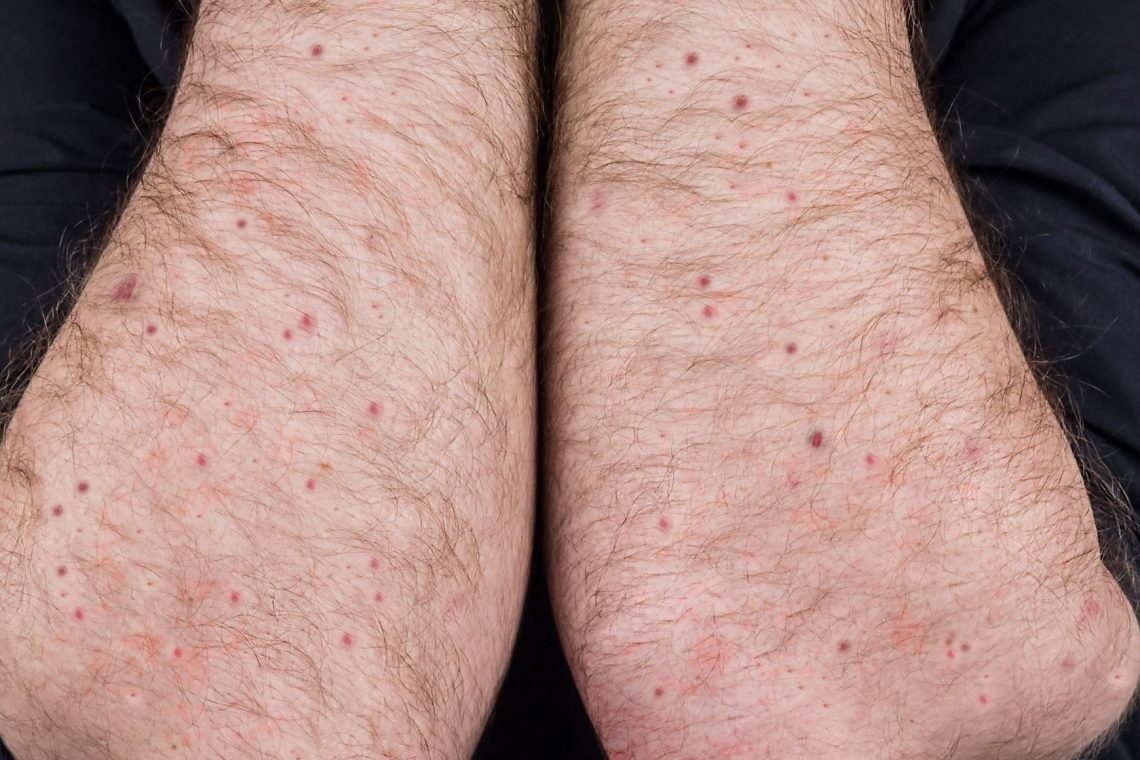 V Nemčiji potrdili prvi primer okužbe z novo različico virusa mpox